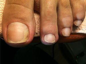 fungal infections of the feet