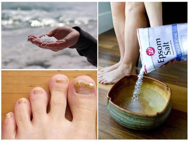 Salt to combat nail fungus