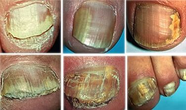 Onychomycosis in an advanced stage
