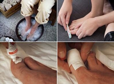 Smoldering feet and application of urea cream on nail affected by fungus