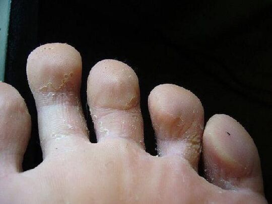what does the fungus look like on the feet