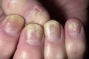 change in the nail with fungal infection