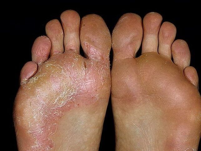 symptoms of a fungus on the foot