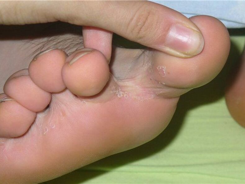 fungus between the toes photo 1