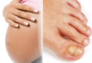 fungal infections of the feet in pregnancy
