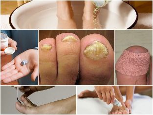 fungal infections of the feet treatment