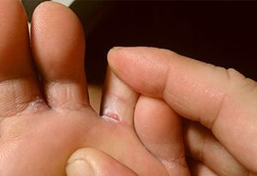 Fungal infections of the feet in adults