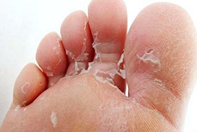 Fungal infections of the feet of the child