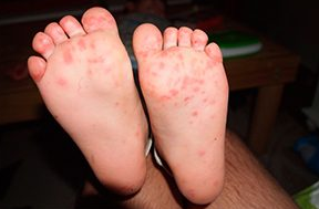 Fungal infections of the feet