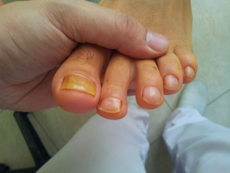 yellowing of the toenails with fungus