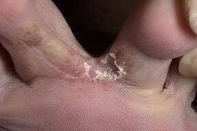 skin fungus between the toes