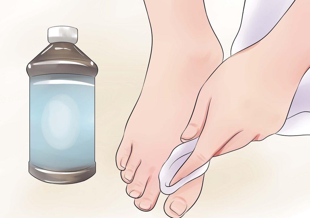 hydrogen peroxide for toenail fungus