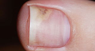 The symptoms of the initial phase of onychomycosis