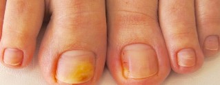 nail fungus of the feet symptoms