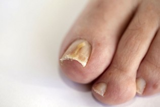 nail fungus of the feet