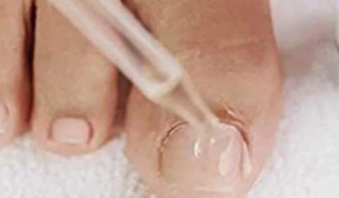 The drops of the nail fungus of the feet