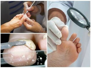 the fungus of the skin of the feet diagnosis