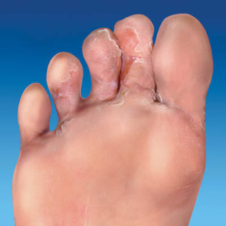 the fungus of the skin of the feet
