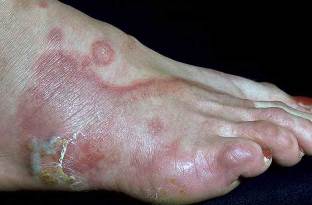 the symptoms of mycosis