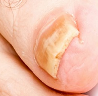 The nail is affected by fungus