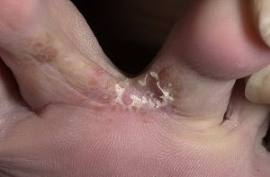 the form of the mycosis of the feet