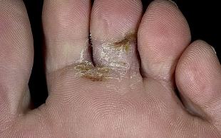 types of mycosis of the feet
